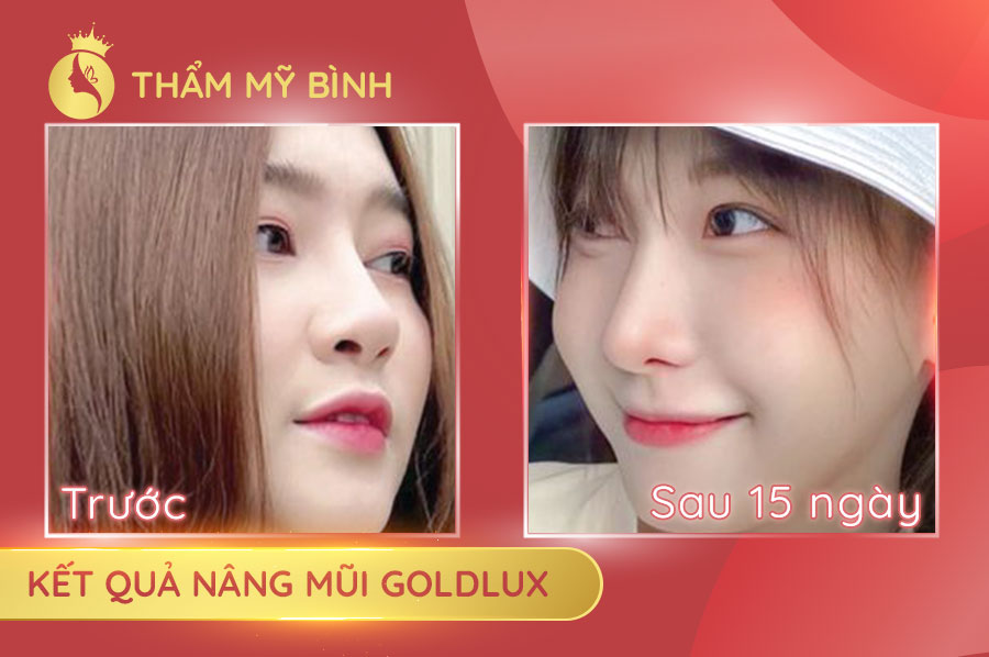 Hình-ảnh-khách-hàng-trước-và-sau-Nâng-Mũi-GoldLux---Siêu-phẩm-mũi-đẹp-tự-nhiên-sau-15-ngày