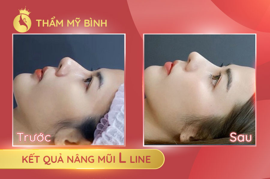 Hình-ảnh-khách-hàng-trước-và-sau-Nâng-Mũi-L-Line-Cao-Tây