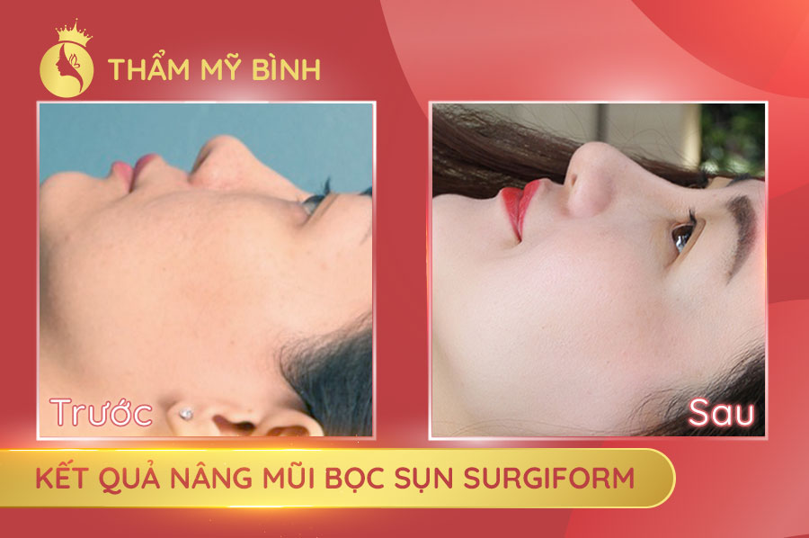 Kết-quả-nâng-mũi-bọc-sụn-Surgiformy